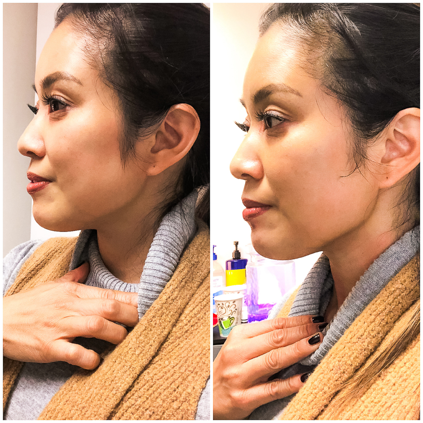 Cosmetics | Review | The Latest Breakthrough Non-Surgical Facelift:  Thermalift featured by top Dallas beauty blog Cute & Little