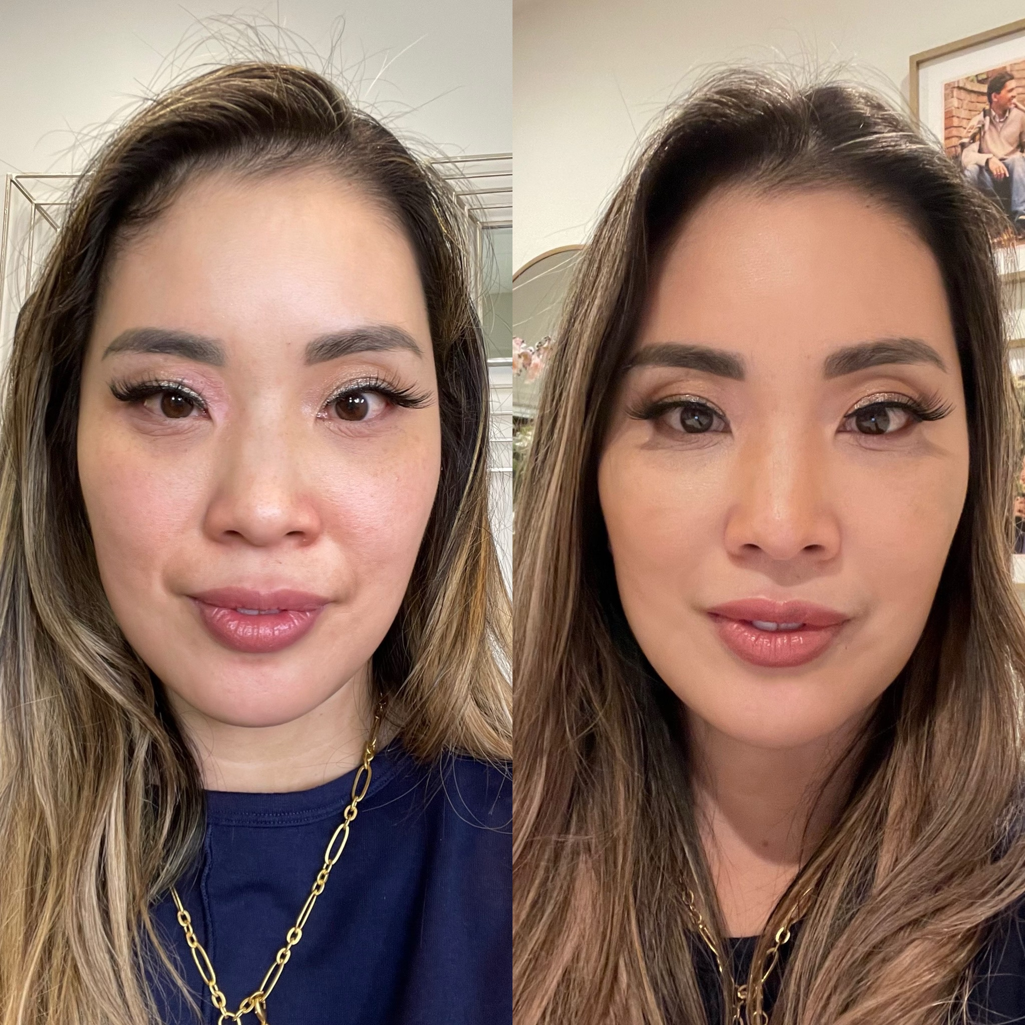 cute & little | dallas beauty lifestyle blogger | RHA filler review | before / after | laugh lines, nasolabial folds, mental crease